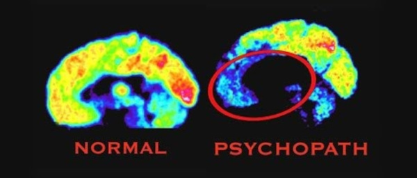Мозок людини і психопата